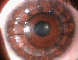 角膜移植.jpg 角膜移植.jpg