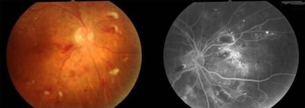 视网膜中央动脉是颈内动脉的分支，它和供应脑部的动脉一样，彼此之间无吻合支，属于终末动脉，一旦发生阻塞，血流中断即成为视网膜中央动脉阻塞，被供应区的视网膜立即缺氧、变性。两小时以后，即使 了血供，视力遭受严重破坏，很难 。因此，视网膜中央动脉阻塞是眼科的一种危重急症，必须予以紧急诊治。.jpg