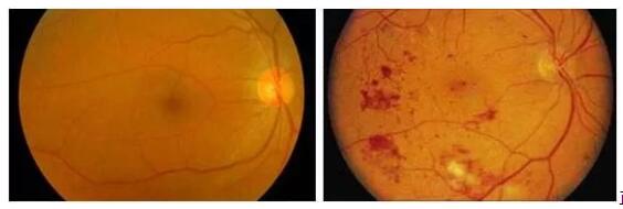 70%的糖尿病患者会出现全身小血管和微血管病变，影响全身组织的供养，进而导致一系列严重的并发症。糖尿病也可以引起一系列眼部疾病，包括白内障、青光眼、眼球运动障碍等，其中较为严重的就是糖尿病视网膜病变，它可以严重影响视力的一种疾病，已经成为四大主要致盲疾病之一。糖尿病引起的失明者比一般人高10到25倍。据有关资料统计，糖尿病患病时间越长，患者出现视网膜病变的比率越大。.jpg