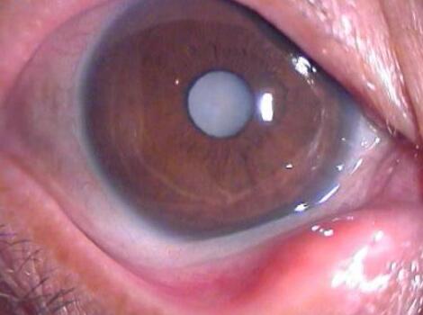 　　白内障是指眼睛的晶状体由透明变成不透明，阻碍光线进入眼内，从而影响了视力。初期混浊对视力影响不大，而后逐渐加重，直至明显影响视力甚至失明。我国目前约有500 人患有白内障，每年新增40 人，80岁以上老年人的白内障发病率近99%，随着我国老龄化进程的加剧，白内障在我国的发病人数仍有升高趋势。.jpg