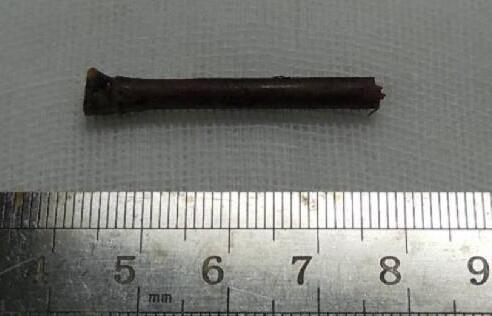 “小小竹棍把我害的好苦啊!幸好，遇到了厦门眼科中心眼整形科的胡继发副主任。医术好、态度好。大医院 医生就是不一样!”——医治眼睛后的老李激动的说道2.jpg