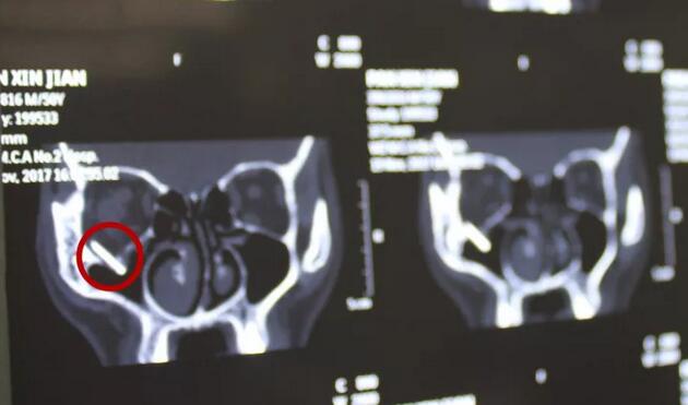 当地的医生跟我说，如果做手术他们只有50%的把握能把我爸眼睛里的东西取出来，而且还不知道会不会伤到眼睛其他部位，我实在是不放心。”刘先生的儿子回忆道。孝顺的儿子不想让爸爸的眼睛承受“50%失败的可能性”，在经过多方打听后，知道福州眼科医院副院长、眼眶病科李谦益主任是这方面的“好手”,他决定带着爸爸到福州寻找 .jpg