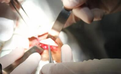 当地的医生跟我说，如果做手术他们只有50%的把握能把我爸眼睛里的东西取出来，而且还不知道会不会伤到眼睛其他部位，我实在是不放心。”刘先生的儿子回忆道。孝顺的儿子不想让爸爸的眼睛承受“50%失败的可能性”，在经过多方打听后，知道福州眼科医院副院长、眼眶病科李谦益主任是这方面的“好手”,他决定带着爸爸到福州寻找 3.jpg