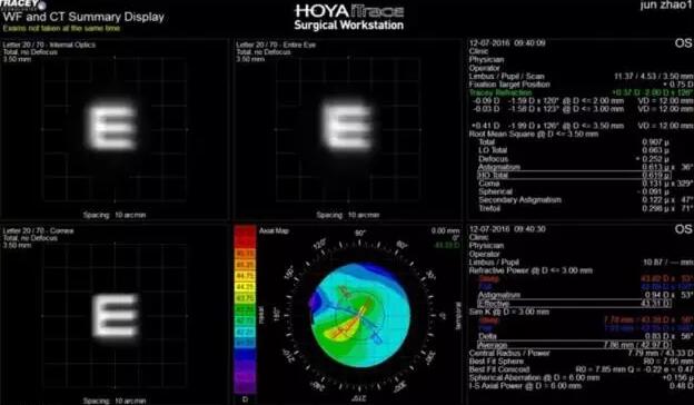 白内障手术已发展至屈光手术时代(一*次白内障屈光手术可解决白内障、老花眼、近视眼、远视眼、散光等多种眼病)，手术 对于眼科医生来说变得更加容易，而术前准确的诊断、评估、测量和计算，为患者设计个性化的手术方案，成为白内障医生面对的难题。2.jpg