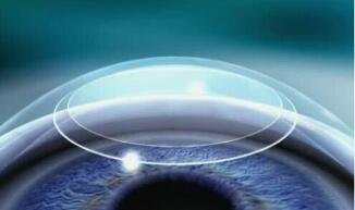 全飞秒激光近视手术.jpg 全飞秒激光近视手术.jpg