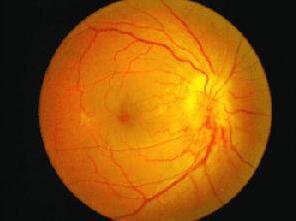 糖尿病除了引起心、脑、肾等全身多脏器损害，也引起多种眼病， 如：糖尿病性视网膜病变、白内障、新生血管性青光眼、视神经病变、葡萄膜炎、眼肌麻痹复视等。所以医生建议糖尿病患者要检查眼底。糖尿病患者应该定期去眼科检查.jpg