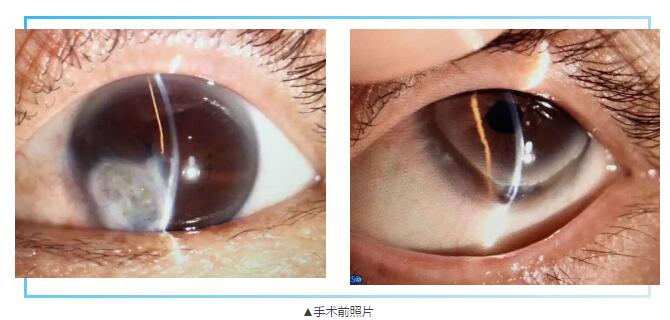 即便天气如此恶劣，合肥名人眼科医院的所有医护人员依然兢兢业业的守护在自己的岗位上。其中有两位患者分别来自安徽的蒙城和涡阳，一 角膜愈着性白斑，致虹膜前后黏连，视力仅有手动。另一 角膜严重边缘变性致穿孔，急需通过角膜移植手术保住眼球。2.jpg