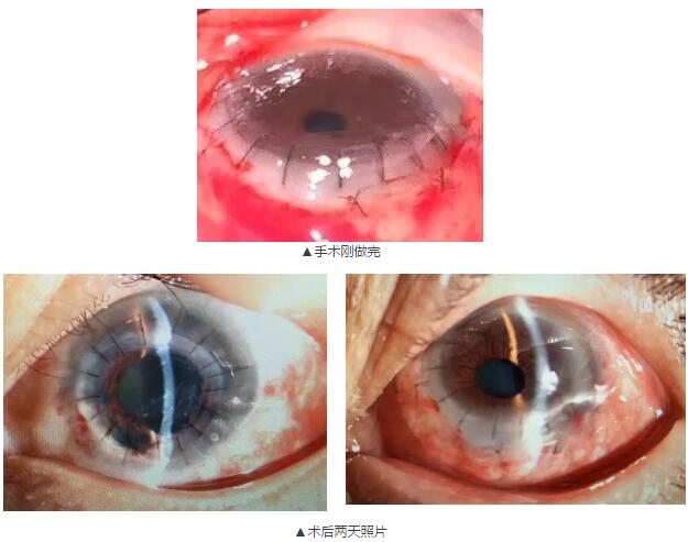 即便天气如此恶劣，合肥名人眼科医院的所有医护人员依然兢兢业业的守护在自己的岗位上。其中有两位患者分别来自安徽的蒙城和涡阳，一 角膜愈着性白斑，致虹膜前后黏连，视力仅有手动。另一 角膜严重边缘变性致穿孔，急需通过角膜移植手术保住眼球。.jpg