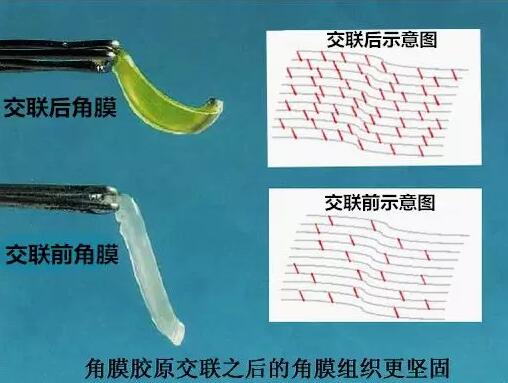 角膜胶原交联(Corneal Cross Linking，CCL)医治：使用370纳米波长的紫外线，激活核黄素(一种光敏感剂)，使其转化成活性氧族，活性氧族再诱导角膜胶原纤维的氨基之间发生化学交联反应，使角膜胶原纤维直径增粗、提*角膜基质对多种降解酶作用的抵抗力等多重生物学效应，从而使角膜基质的机械强度增加2.jpg