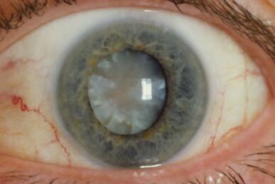 白内障手术.jpg 白内障手术.jpg