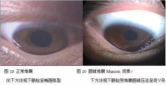 每年寒假期间，厦门眼科中心都会接诊不少学生圆锥角膜患者。大部分学生都是出现了近视、散光,戴眼镜  不佳的情况下来就诊的。厦门眼科中心眼表及角膜病专科吴护平主任提醒：青少年视力下降明显要警惕圆锥角膜1.jpg