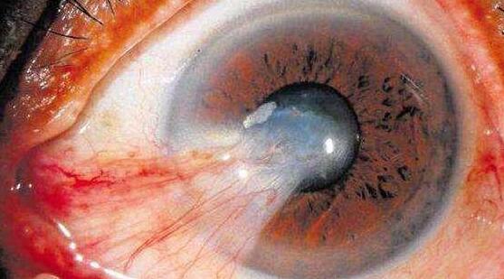 据烟台康爱眼科医院的眼病普查结果显示，当天共筛查149人， 大的94岁， 小的47岁。其中，24人因翼状胬肉急需手术医治，还有12人患有轻度翼状胬肉需随诊。1.jpg