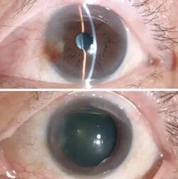 姚颖医生为文先生做了详细检查后，制定了左眼的翼状胬肉切除术、联合自体干细胞移植术、联合羊膜覆盖术的手术方案，这才为他解决了胬肉的麻烦与痛苦。手术一个月后，朋友见了文先生都说他的眼睛  了正常，看不出一点手术过的痕迹2.jpg