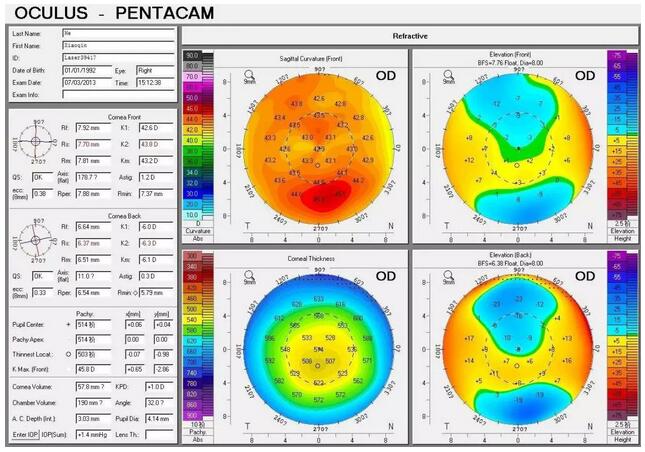 圆锥角膜是一种角膜扩张性疾病，患病后角膜中央或偏中央区域会发生局部变薄向外扩张，导致散光，并随着病情进展逐渐出现视力下降、 不良、视物扭曲变形、虹视等，极大影响生活，严重者可致盲。.jpg
