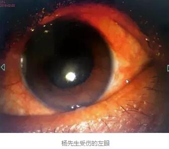 白内障和青光眼都是致盲性眼病，其中青光眼的病程不逆转。杨先生拖延伤情导致同时并发白内障、青光眼的情况，十分令人惋惜。”出名眼科专家、成都易游体育陈晓明教授表示2.jpg