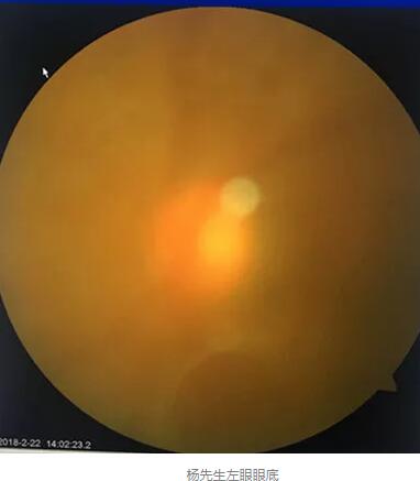 白内障和青光眼都是致盲性眼病，其中青光眼的病程不逆转。杨先生拖延伤情导致同时并发白内障、青光眼的情况，十分令人惋惜。”出名眼科专家、成都易游体育陈晓明教授表示3.jpg