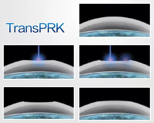 目前，近视手术已被列入军检允许范围，安全、长效的近视手术，已经成为了众多有志青年应征入伍前的必然选择。在众多摘镜手术方式——全飞秒、半飞秒、准分子激光手术、ICL晶体植入术等等，哪一种 适合当兵的人呢3.png
