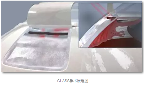 成都易游体育已经开展的青光眼手术有：引流阀 (钉)植入手术(2015年以来已200多 )，360°Schlemm's管切开术，激光CO2 辅助巩膜深层切除术，小梁切除术青(光眼)白(内障)联合手术。还有虹膜周切术、前房成形术、 虹膜复位术，睫状体冷冻术，小梁切开术和前房穿刺术等4.png