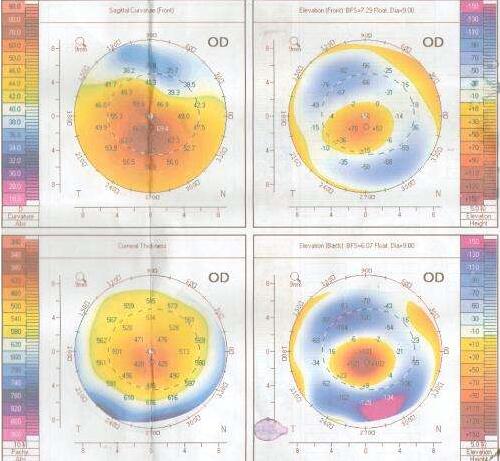 如果角膜厚度不适合角膜屈光手术，可以进行ICL晶体植入术进行 .jpg