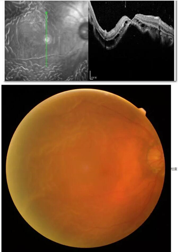李老太在毫无征兆的情况下右眼视力下降至看不见东西。李老太家人带其至县医院就诊。医生诊断为视网膜脱离，需做玻切手术医治，而玻切手术需要动手术2次。怕疼的李老太一听就犯怵了：开刀，疼。 终，李老太的家人在多方打听后决定带李老太至宜昌易游体育找许大玲院长医治1_副本.jpg
