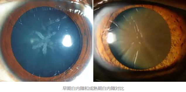 白内障超声乳化术是如今新式微创白内障手术，它创伤小、愈合快，术后 二天 正常生活。老年人能不能承受得住白内障手术呢2.jpg