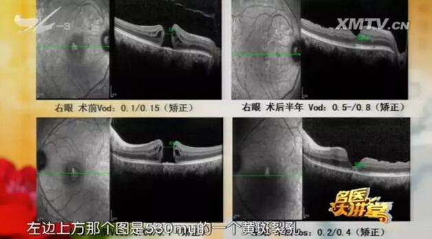 黄斑裂孔是一种常见的黄斑病，是黄斑部视网膜内界膜至感光细胞层发生的组织缺损所引起的。黄斑区位于眼睛视网膜中央，它是视力 敏感区，负责视觉和色觉的视锥细胞就分布于该区域，因此 累及黄斑部的病变都会引起中心视力的明显下降、视物色暗、变形等3.jpg