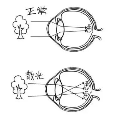 近视加散光想要 ，飞秒全激光近视手术是很好的选择。 一*次近视激光手术，就可以同时 近视、合并散光。1.jpg