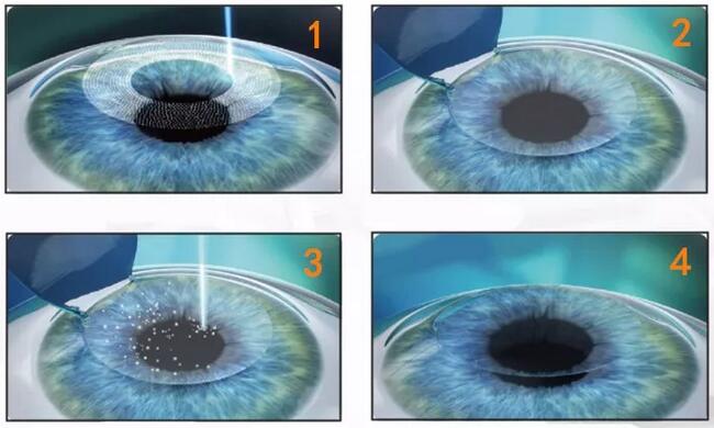 近视加散光想要 ，飞秒全激光近视手术是很好的选择。 一*次近视激光手术，就可以同时 近视、合并散光。2.jpg
