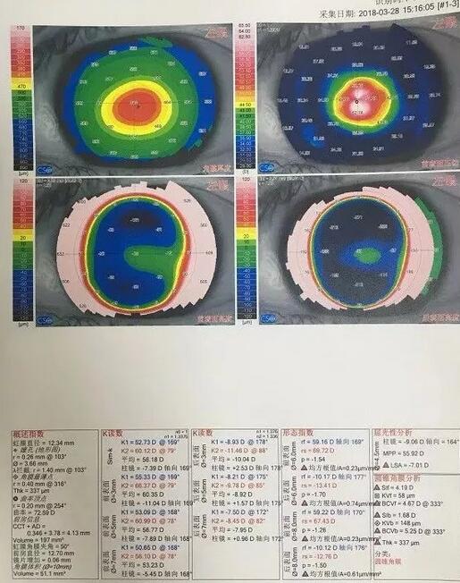 角膜移植是利用异体的正常透明角膜组织，取代浑浊病变的角膜组织，使患者复明或控制角膜病变，这在目前同种器官移植当中， 率是 高的，也是重要的复明手术之一。”在 为一位饱受圆锥角膜之苦患者 实施角膜移植之后，卢敏院长也对患者极为关心的角膜移植相关知识进行介绍。比如哪些患者适合角膜移植手术