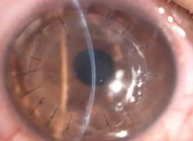 厦门眼科中心商旭敏博士介绍：角膜移植手术在所有器官移植中属于排斥反应 少的手术，随着手术器械的改进，以及手术技术的提*，目前角膜移植的 率越来越高，如排斥率较低的圆锥角膜， 率就可达到90%以上1.jpg