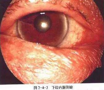 在内翻倒睫还没有造成角膜的炎症损害时，通过手术是可以 愈合的;但如果等到出现了角膜炎症，很可能就会形成角膜瘢痕，此时手术解决眼睑内翻现象，患者不会再流泪、畏光，角膜瘢痕对于视力的损害是无可避免1.jpg