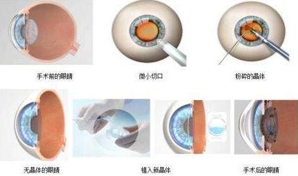 三焦点人工晶体手术原理：置换掉人眼老去的晶体，世代的晶体不仅有非常好的弹性，以往传统的白内障手术只是单纯的脱盲复明手术，更多的是解决患者 远视力。而三焦点人工晶体的问世，彻*解决了传统白内障术后仍需配镜的问题，实现了从以往‘看得见’到‘看得清、看得好’的转变.jpg