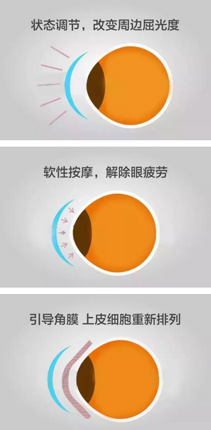 角膜塑形镜是一种硬性透气性隐形眼镜，戴在眼表可使角膜发生塑形效应，从而达到 近视度数的 。适合夜晚睡觉时配戴，白天不用戴眼镜就可以 裸眼视力，不影响学习、运动2.png
