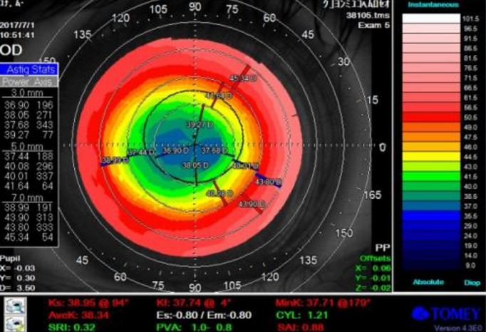 摘镜手术会不会术后近视反*? 摘镜手术会不会术后近视反*?