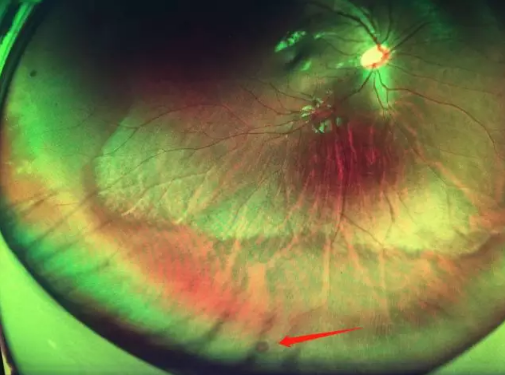 想要摘镜参军在深圳易游体育查出视网膜裂孔 细心妈妈挽救孩子视网膜1.png