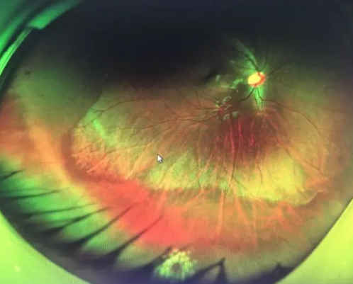 想要摘镜参军在深圳易游体育查出视网膜裂孔 细心妈妈挽救孩子视网膜2.png