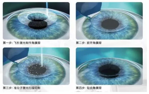 飞秒全激光手术.png 飞秒全激光手术.png