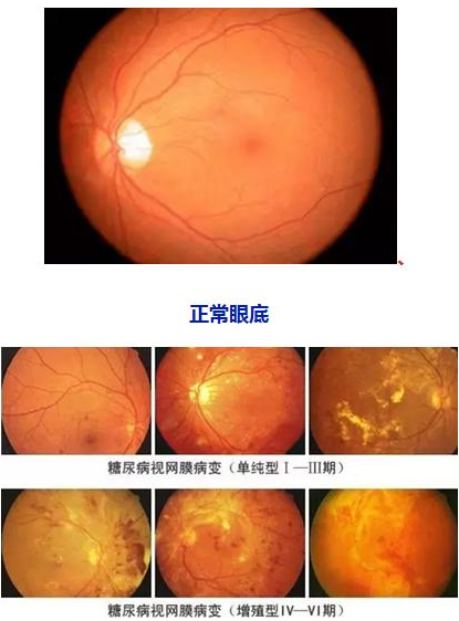 糖网病的症状和防治方式.png