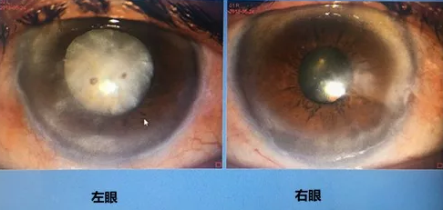 同时患 青光眼、白内障老婆婆辗转几家医院之后终于在成都易游体育顺利手术2.png