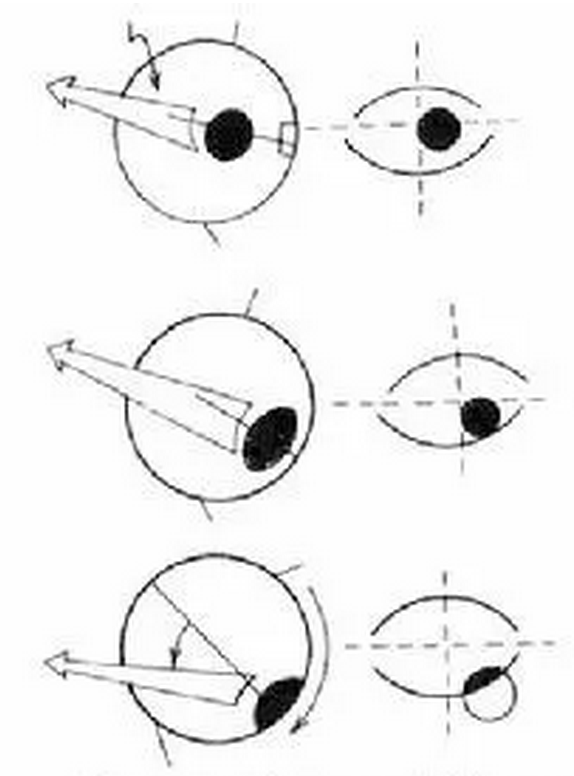 眼球后退综合症的类型与医治方式1.png