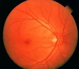 高度近视有哪些症状?1.png 高度近视有哪些症状?1.png