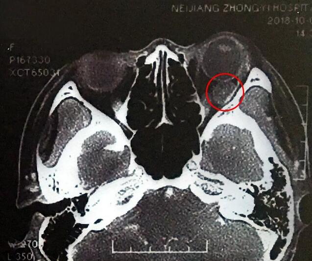 成都易游体育罗清礼教授为眼眶肿瘤患者顺利进行手术1.jpg 成都易游体育罗清礼教授为眼眶肿瘤患者顺利进行手术1.jpg