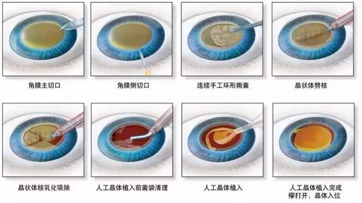 叶院长哪一种白内障手术 ，术后视觉 更好？.jpg