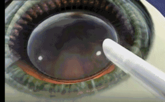 想要当兵视力不达标怎么办?易游体育有这些摘镜术式帮助你3.gif 想要当兵视力不达标怎么办?易游体育有这些摘镜术式帮助你3.gif