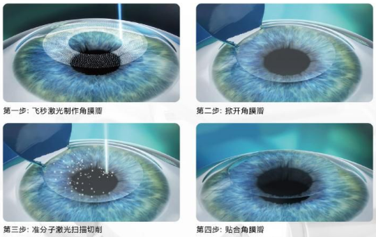 近视无法根治？但你可以这样做？易游体育“有爱就有希望”近视手术火热进行中5.png