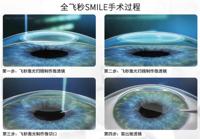 高考毕业后做近视手术，如今近视手术有了越来越高的安全性，且多样的术式可以满足不同患者的摘镜需求。1.png