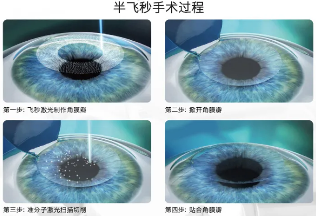 高考毕业后做近视手术，如今近视手术有了越来越高的安全性，且多样的术式可以满足不同患者的摘镜需求。3.png